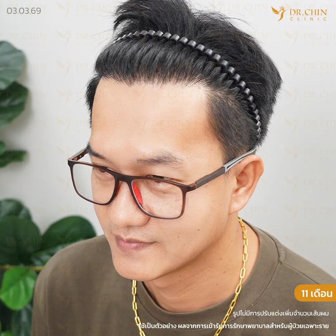 หลังปลูกผม DHI 11 เดือน เคสเติมแนวผมด้านหน้าให้ดูเป็นธรรมชาติ Doctor Chin Clinic