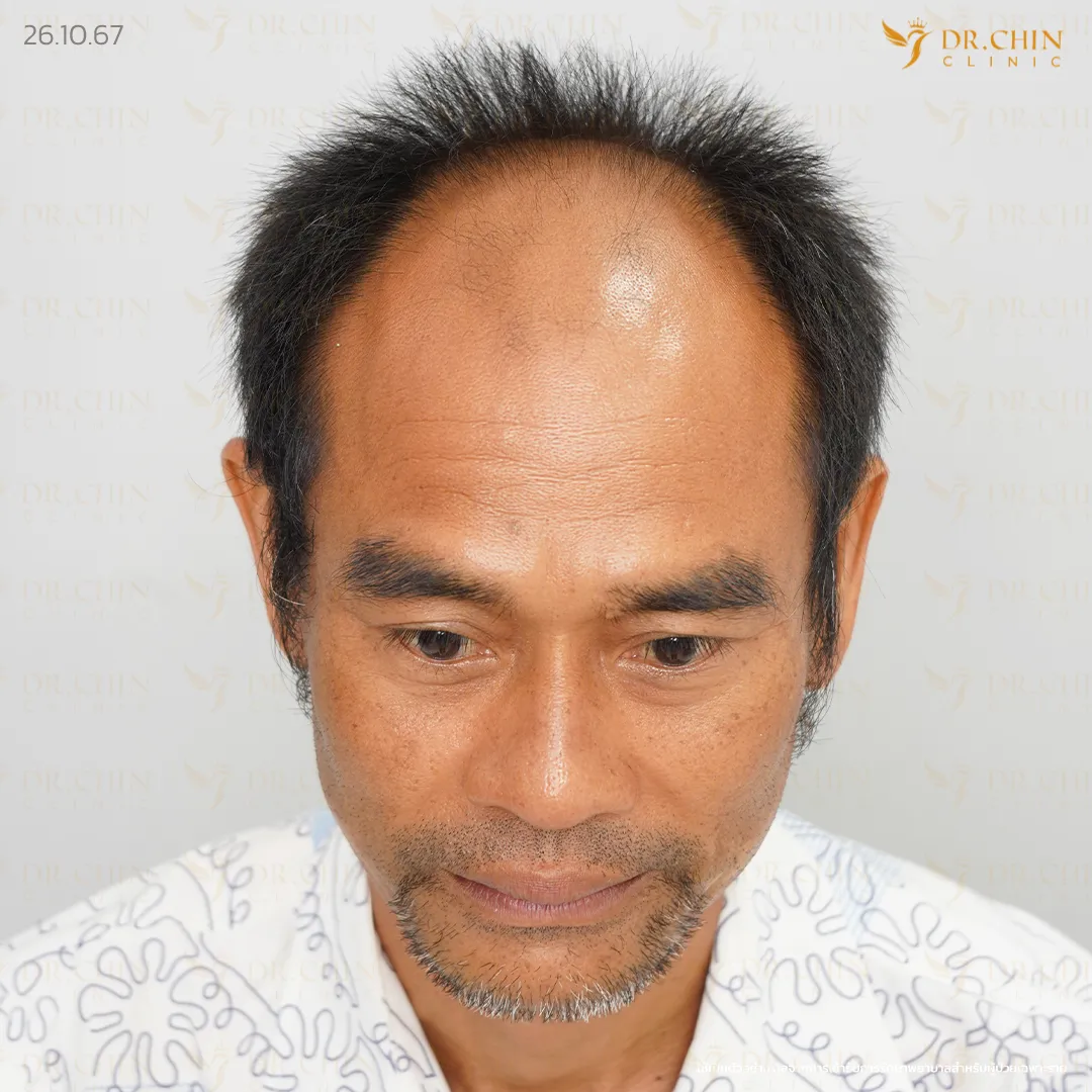 ก่อนปลูกผม DHI เคสแนวผมถอยตามวัยและผมบางด้านหน้า Doctor Chin Clinic