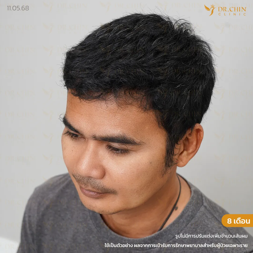 หลังปลูกผม DHI 8 เดือน เคสเติมแนวผมด้านหน้าและขมับให้ดูเต็มขึ้น