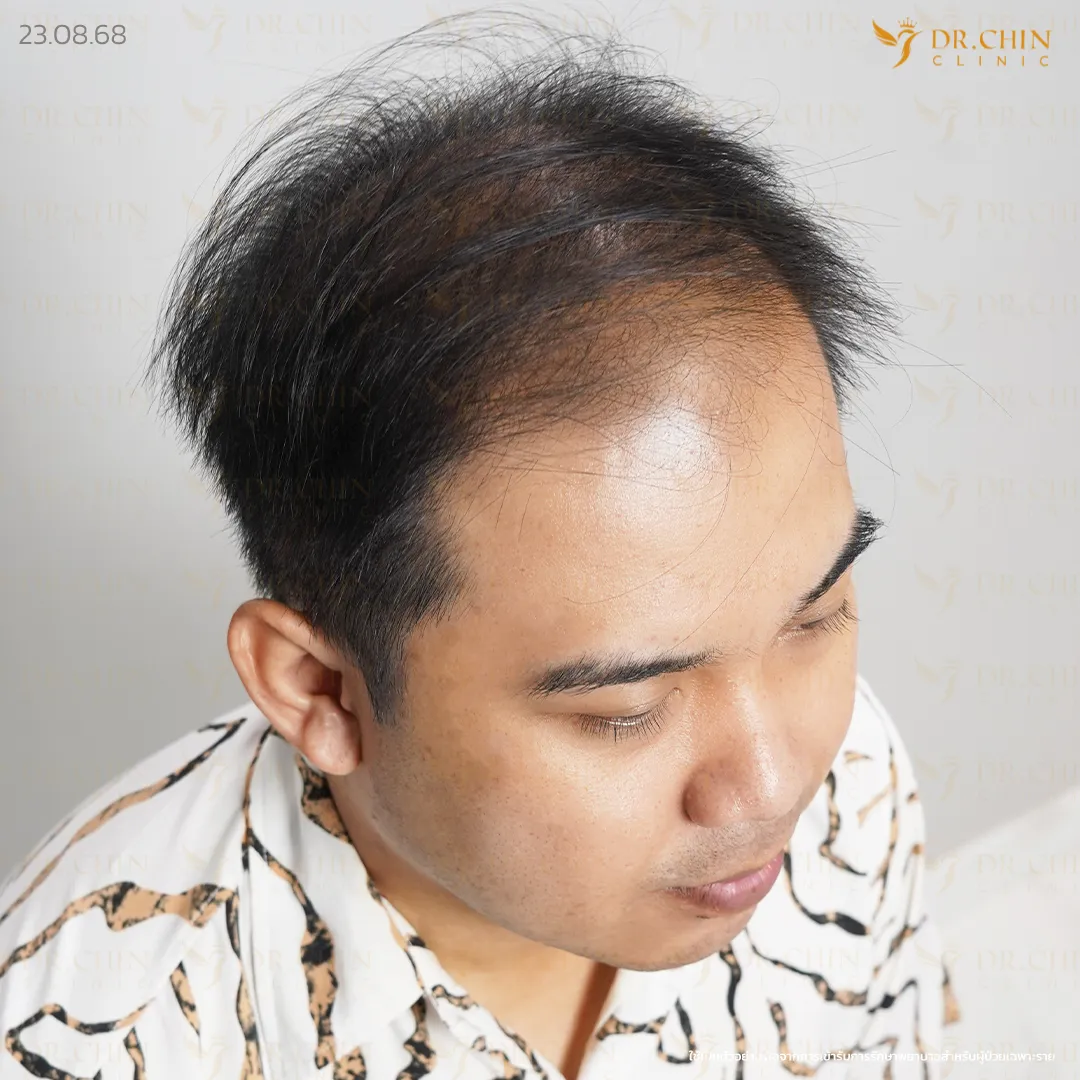 ก่อนปลูกผม DHI เคสแนวผมด้านหน้าถอยและขมับเว้า Doctor Chin Clinic