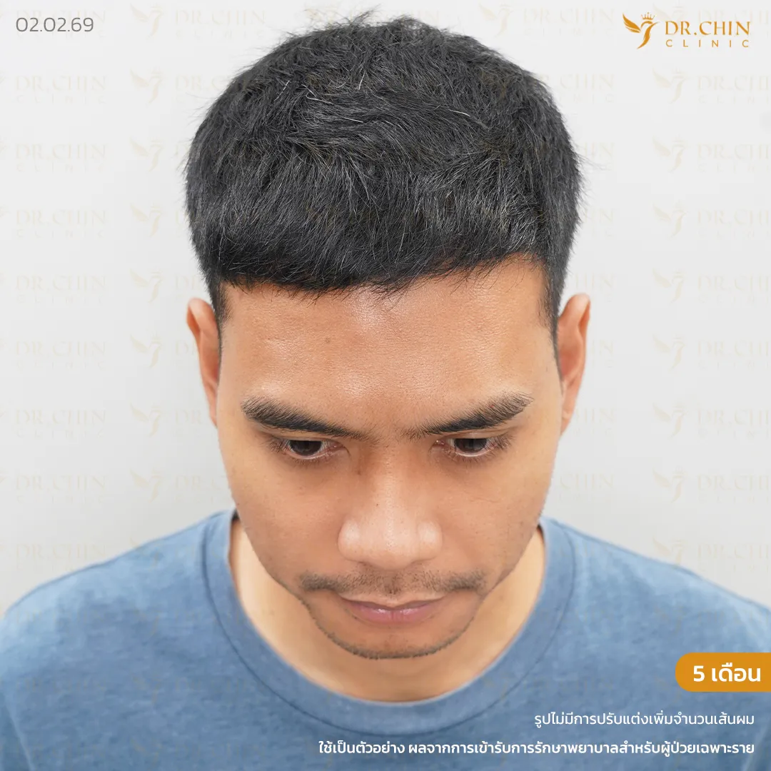 รีวิวแก้ปลูกผมหลังทำ 5 เดือน บริเวณด้านหน้าและกลางศีรษะ