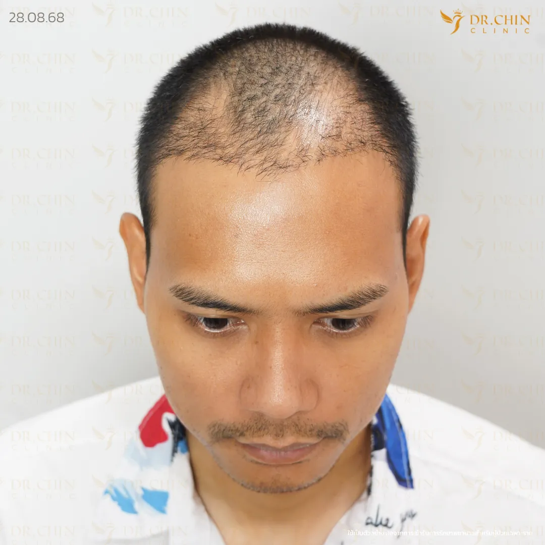 ภาพก่อนแก้ปลูกผม บริเวณด้านหน้าและกลางศีรษะที่ผมบาง