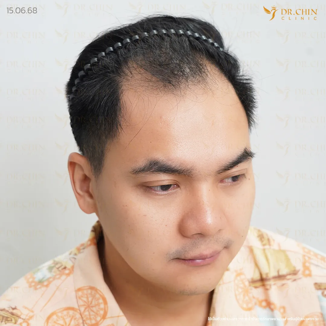 ก่อนปลูกผม MCG เคสแนวผมถอยและผมบางบริเวณด้านหน้า Doctor Chin Clinic