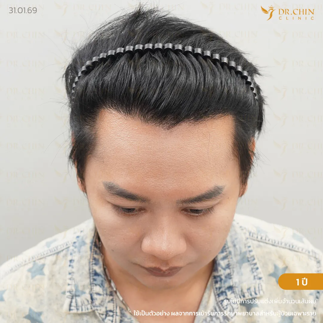 หลังปลูกผมเทคนิค MCG 1 ปี เคสแนวผมตัว M และขมับลึก
