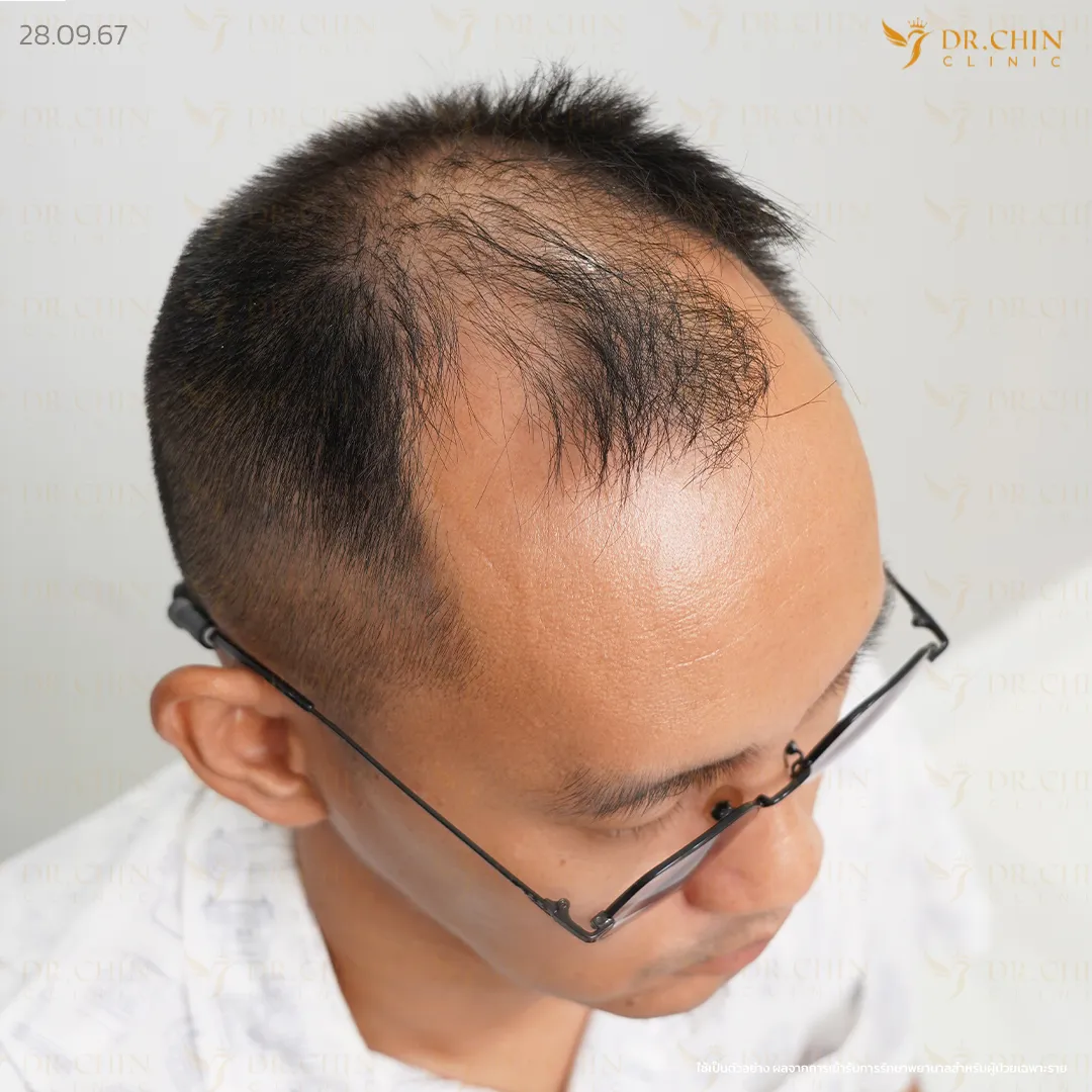 ก่อนปลูกผม MCG เคสผมบางด้านหน้าและกลางศีรษะ Doctor Chin Clinic นครสวรรค์