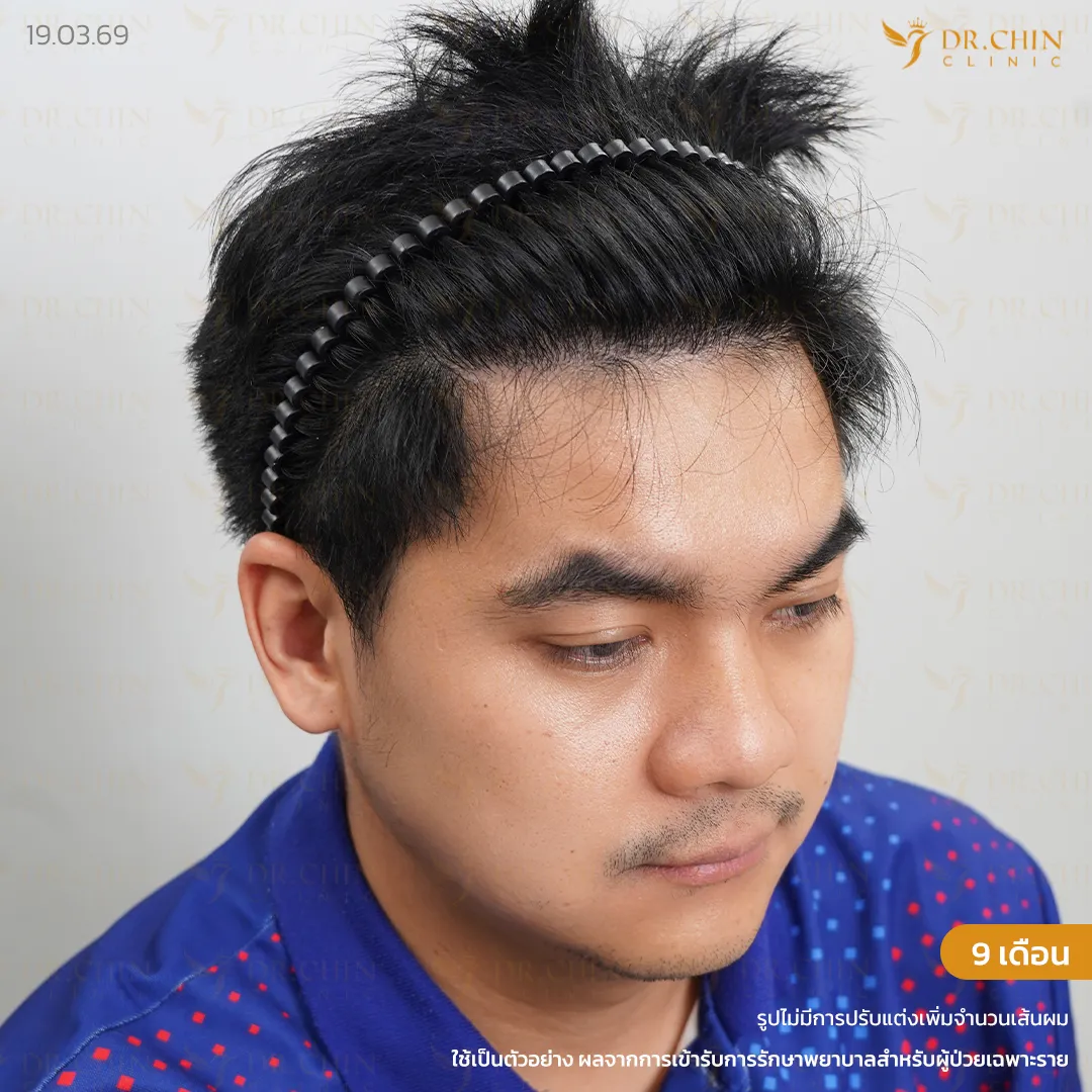 หลังปลูกผม MCG 9 เดือน เคสเติมแนวผมด้านหน้าและขมับให้ดูหนาแน่นขึ้น