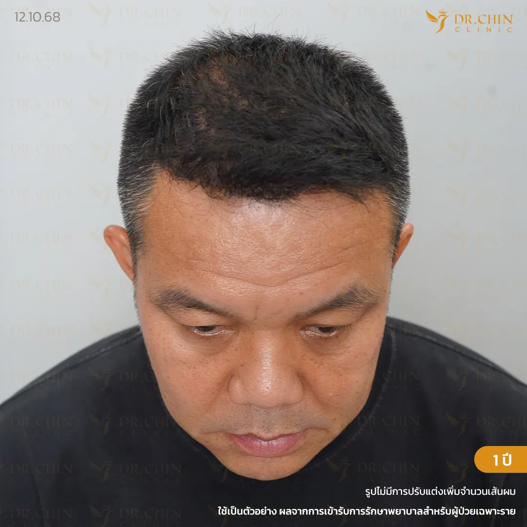 หลังปลูกผม MCG 1 ปี เคสผมบางด้านหน้าและกลางศีรษะ Doctor Chin Clinic