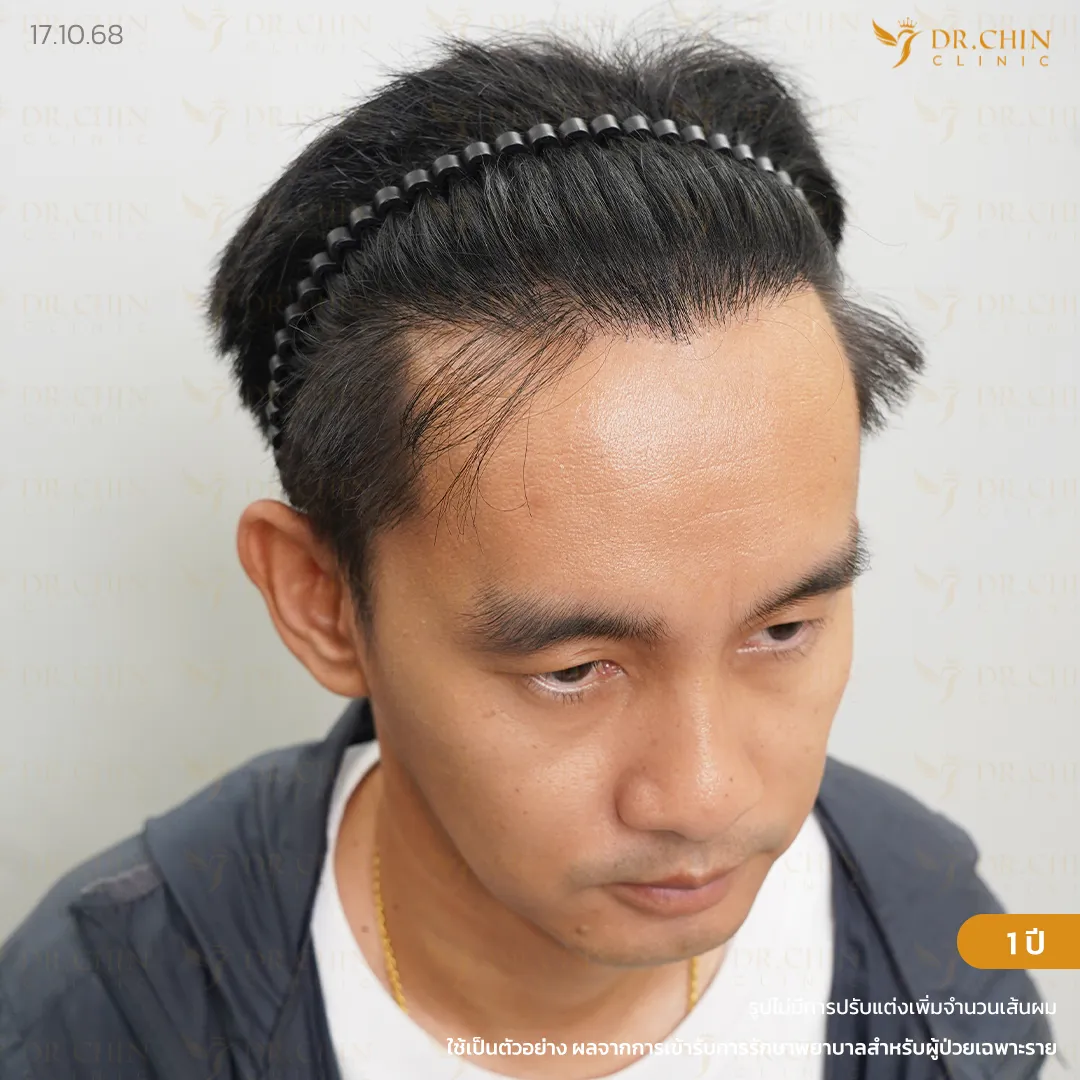 หลังปลูกผม MCG 1 ปี เคสผมบางด้านหน้าและกลางศีรษะ Doctor Chin Clinic