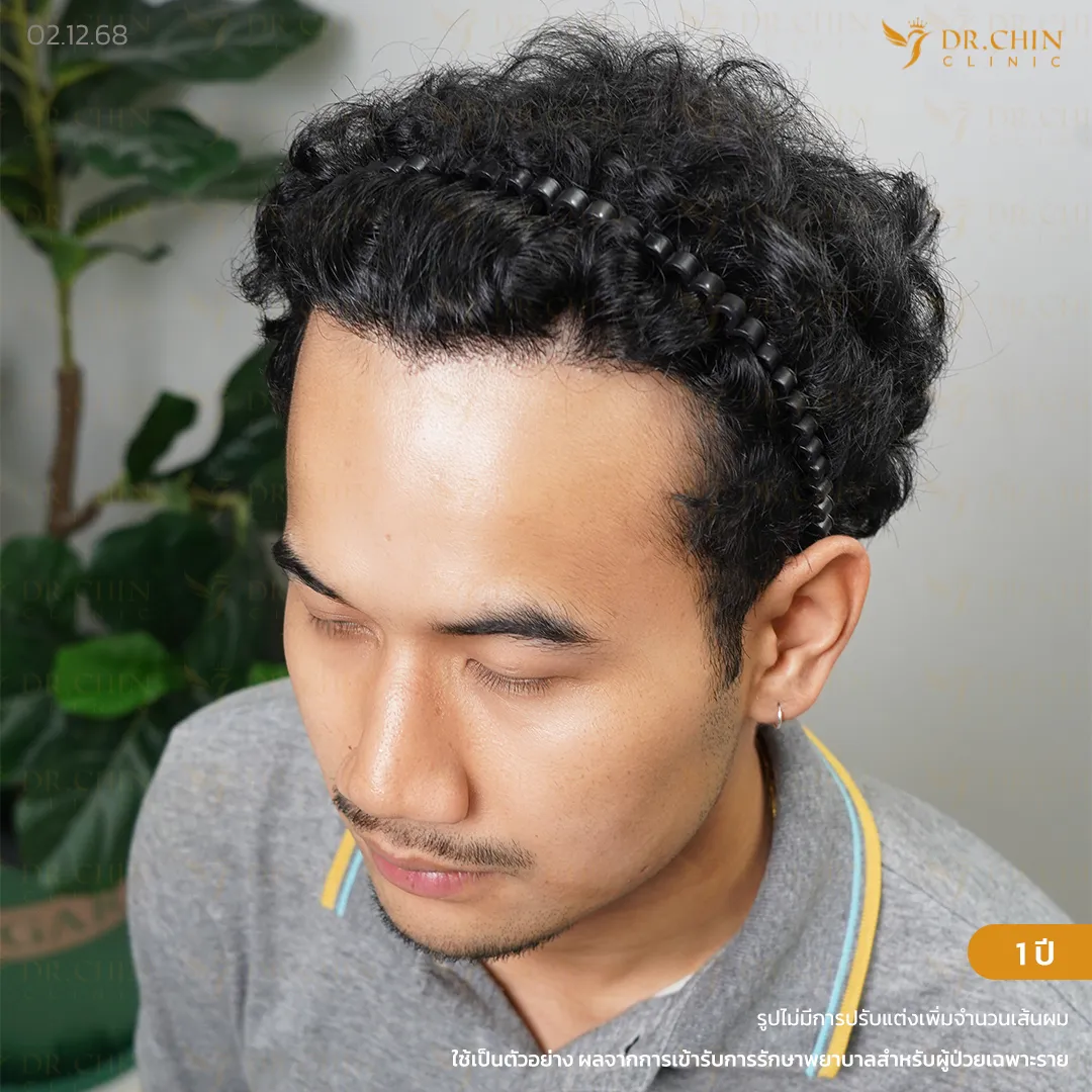 หลังปลูกผม FUE 1 ปี เคสแนวผมด้านหน้าถอยมากและผมบางกลางศีรษะ Doctor Chin Clinic