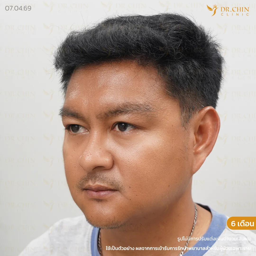 ผลลัพธ์หลังปลูกผม FUE 6 เดือน เคสหน้าผากกว้างและแนวผมร่นแบบตัว M Doctor Chin Clinic นครสวรรค์