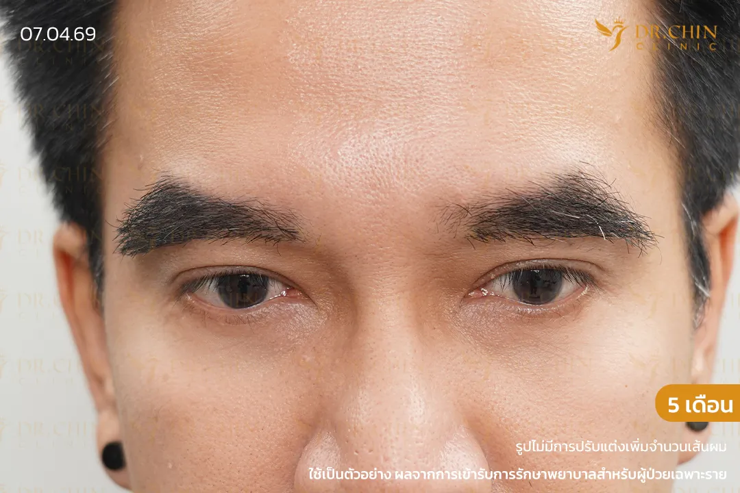 ภาพหลังปลูกคิ้ว 5 เดือน คิ้วหนาแน่นขึ้น เติมทรงคิ้วให้ชัดและรับกับใบหน้ามากขึ้น