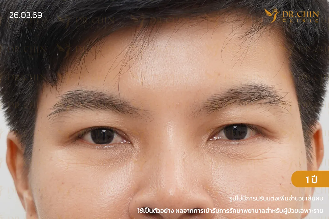รีวิวปลูกคิ้วหลังทำ 1 ปี คิ้วดูหนาขึ้นและเป็นธรรมชาติมากขึ้น