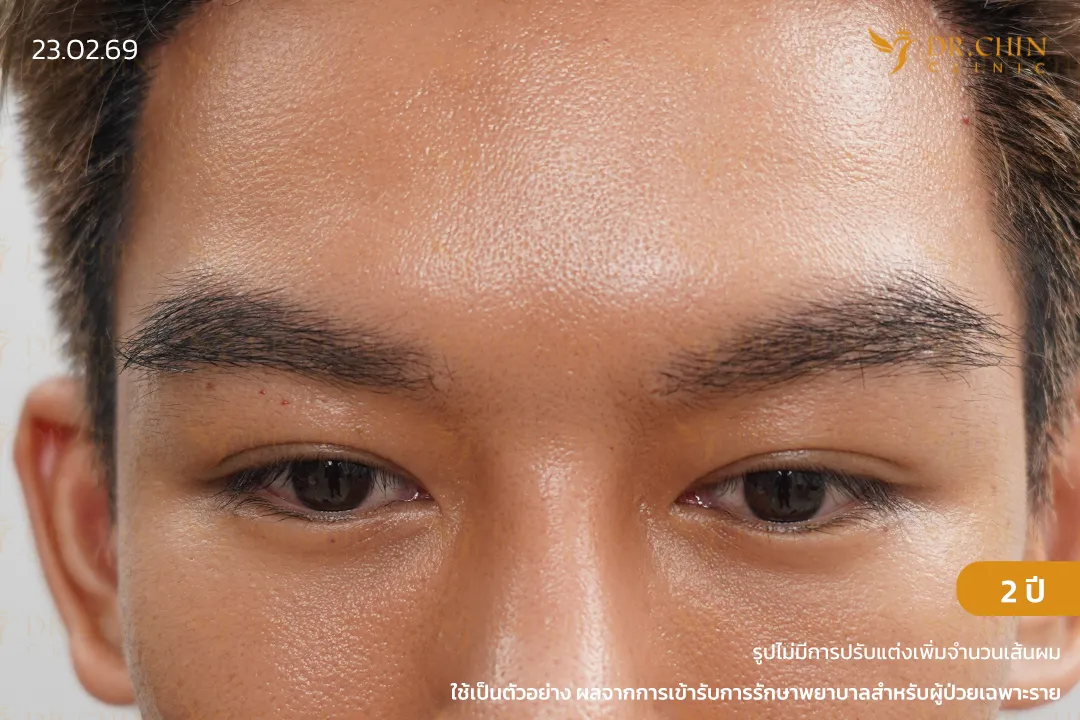 ภาพหลังปลูกคิ้ว 2 ปี คิ้วดูหนาขึ้น ทรงคิ้วชัดขึ้น และเป็นธรรมชาติ ที่ Dr. Chin Clinic นครสวรรค์