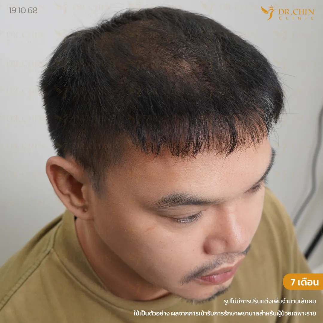 รีวิวปลูกผมทับรอยสักหลังทำ 7 เดือน แนวผมดูหนาแน่นขึ้น