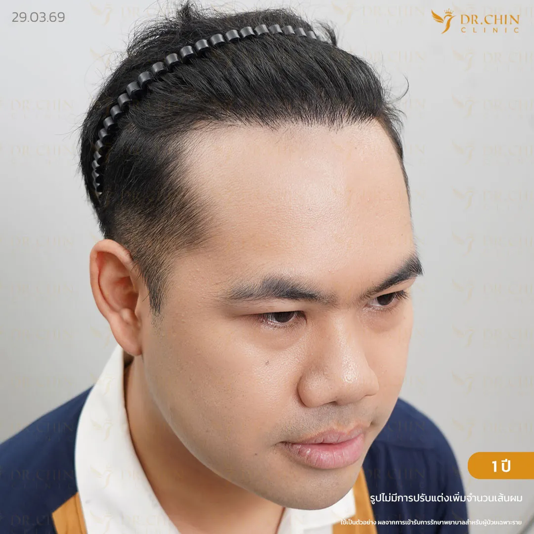 หลังปลูกผม DHI 1 ปี เคสเติมแนวผมด้านหน้าและขมับให้ดูเต็มเป็นธรรมชาติ
