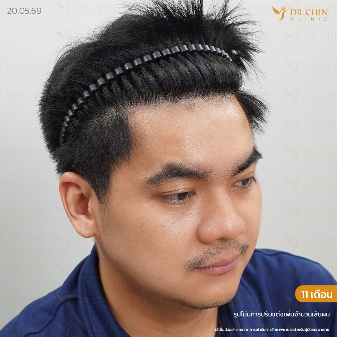 หลังปลูกผม MCG 9 เดือน เคสเติมแนวผมด้านหน้าและขมับให้ดูหนาแน่นขึ้น