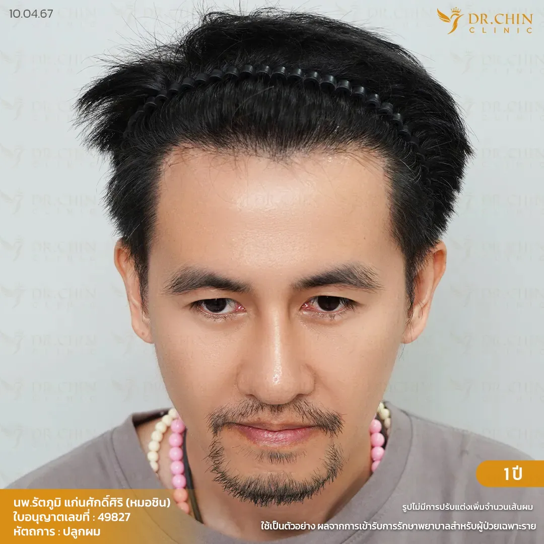 ก่อนปลูกผม