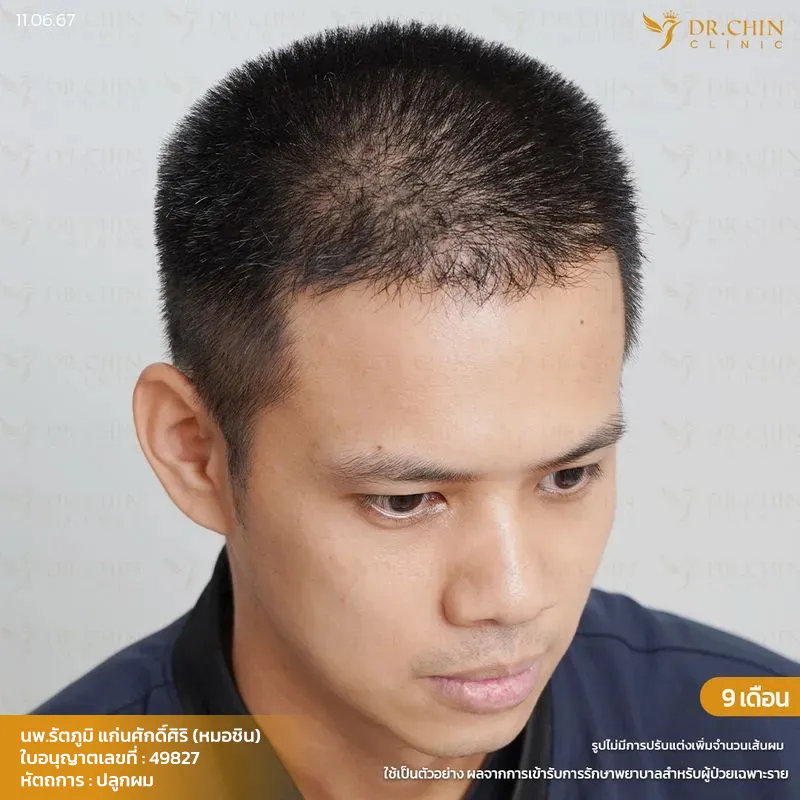 ผลลัพธ์หลังปลูกผม FUE 9 เดือน เคสแก้แนวผมตัว M โดยหมอชิน