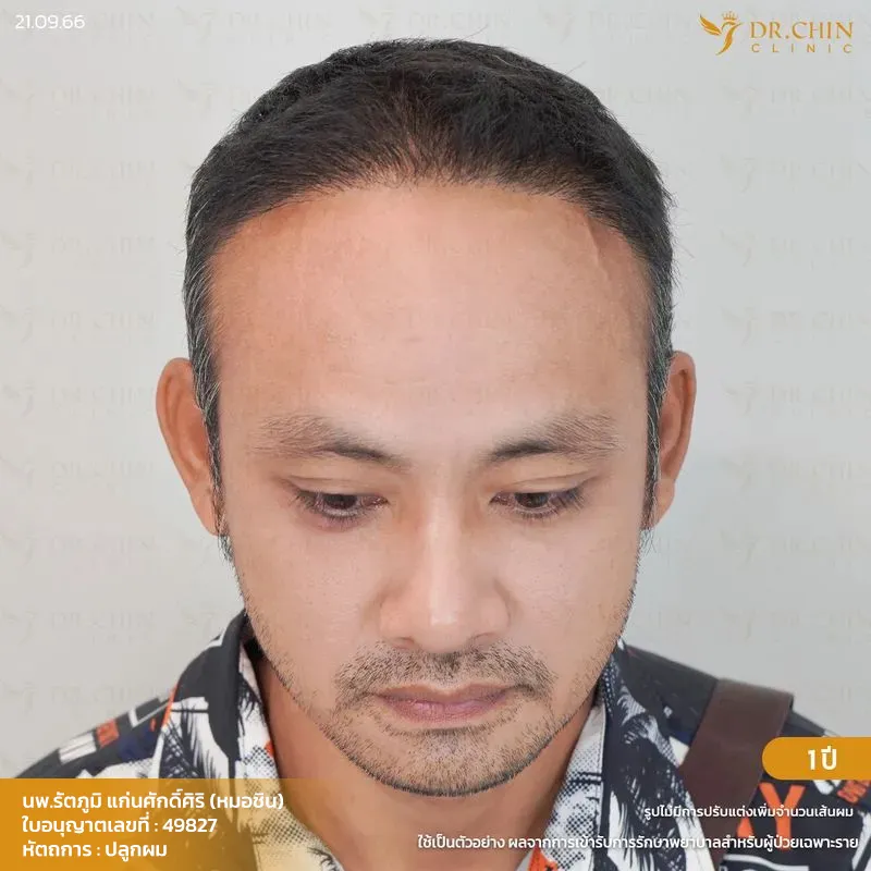 หลังปลูกผม FUE 1 ปี เคสแนวผมด้านหน้าถอยมากและผมบางกลางศีรษะ Doctor Chin Clinic