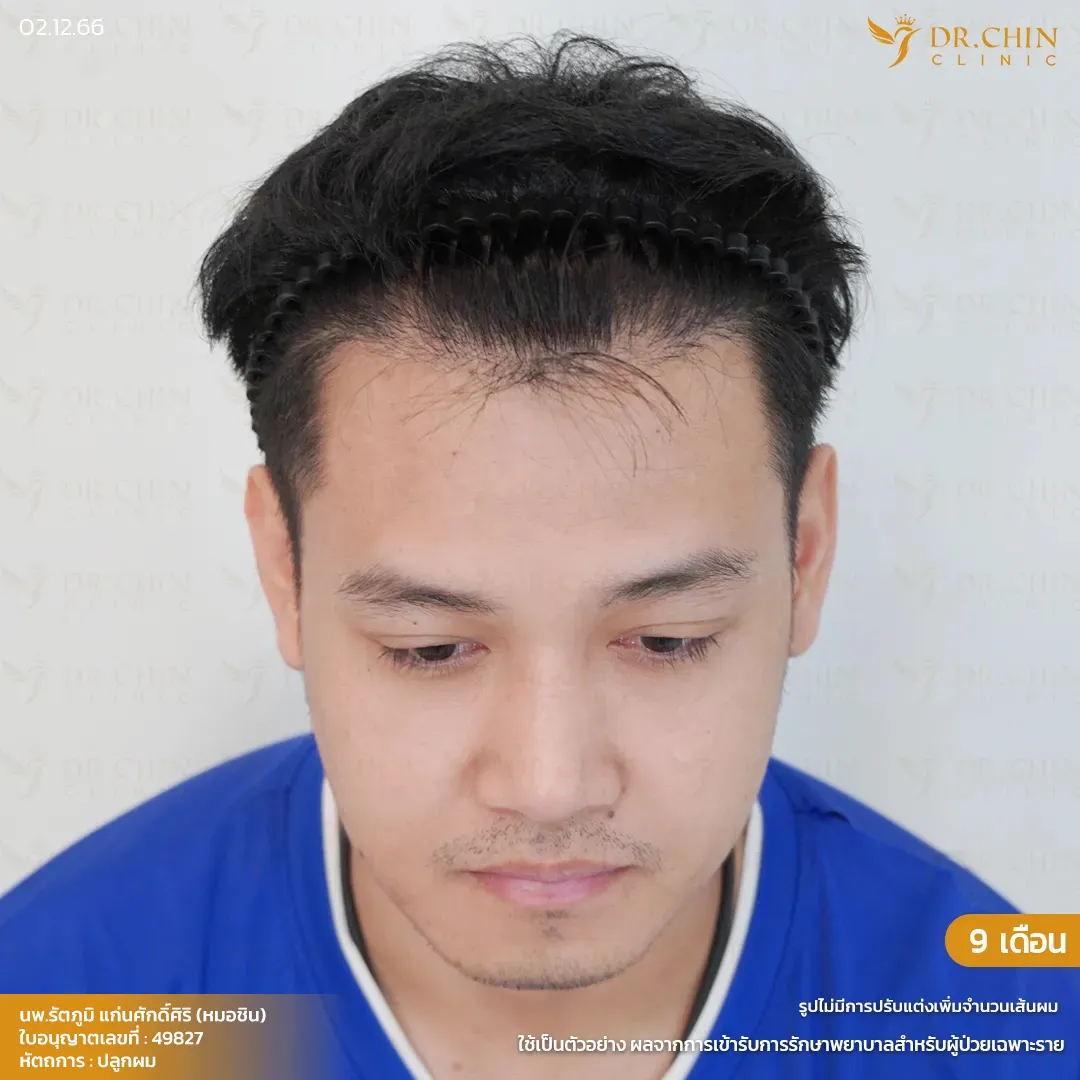 หลังปลูกผม MCG 9 เดือน เคสแก้แนวผมตัว M Doctor Chin Clinic