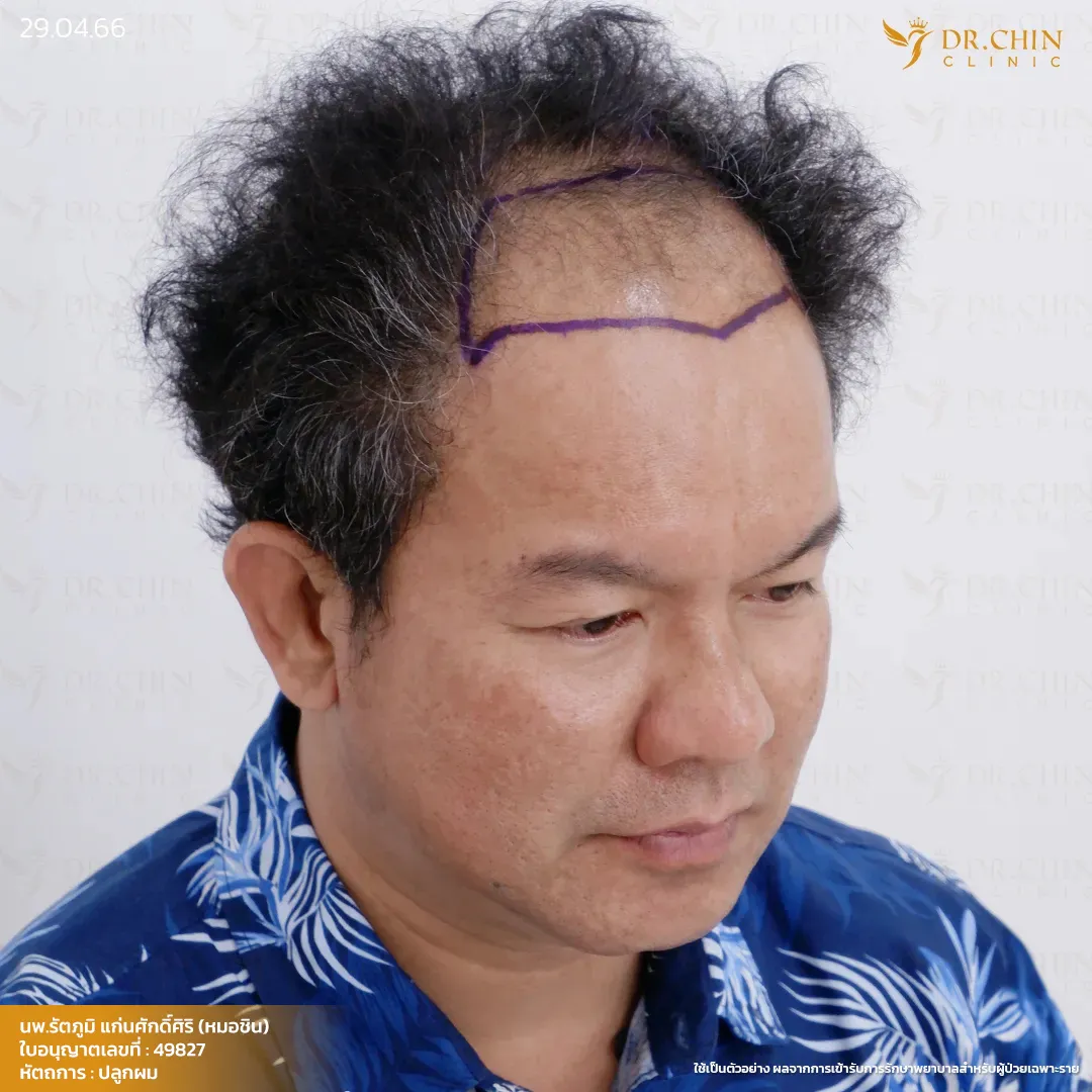 ก่อนปลูกผม MCG เคสผมบางด้านหน้าและกลางศีรษะ Doctor Chin Clinic