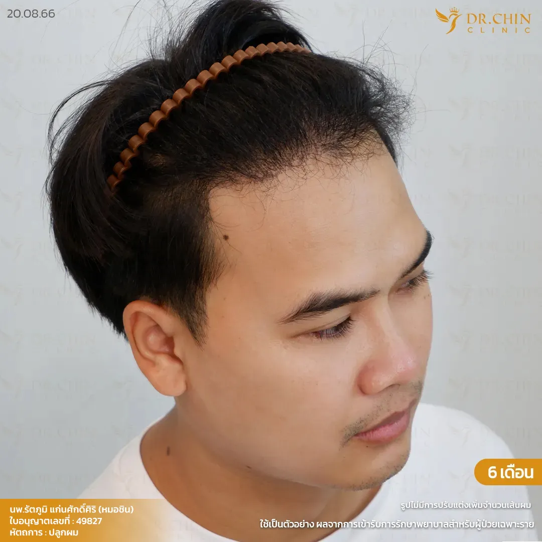 หลังปลูกผม MCG 6 เดือน เคสแก้แนวผมตัว M Doctor Chin Clinic