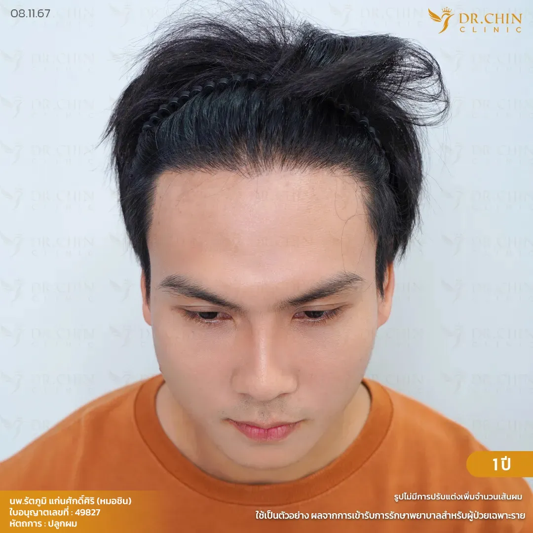 หลังปลูกผม MCG 1 ปี เคสแก้แนวผมเว้าเป็นรูปตัว M Doctor Chin Clinic