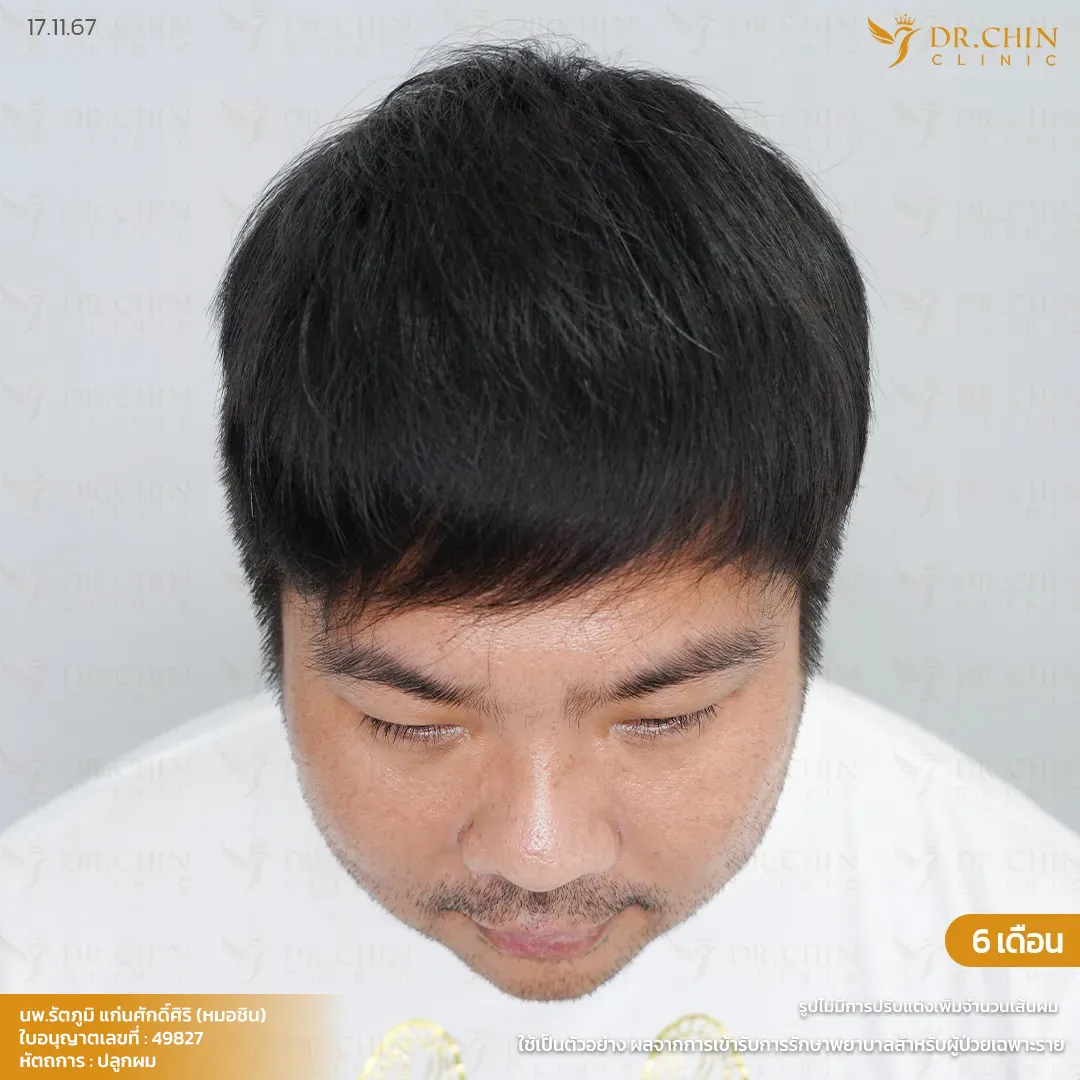 หลังปลูกผม MCG 6 เดือน เคสเพิ่มความหนาแน่นด้านหน้าและกลางศีรษะ Doctor Chin Clinic นครสวรรค์