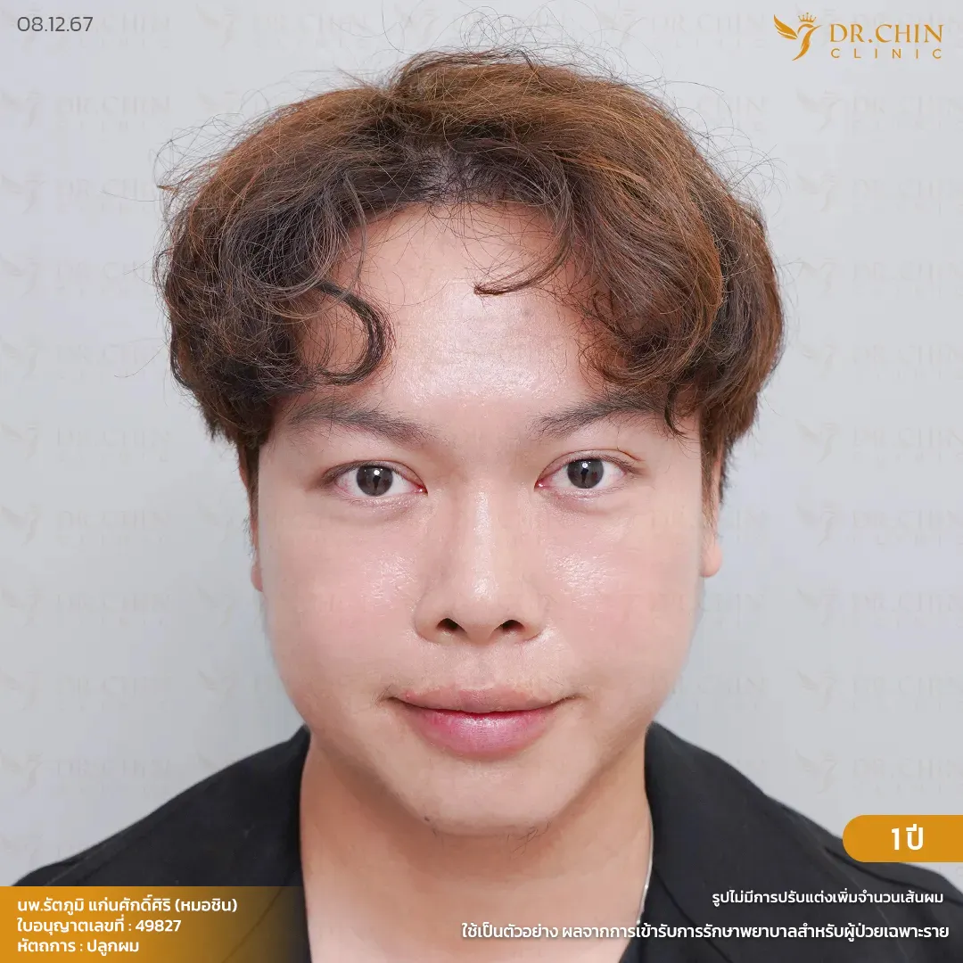 ผลลัพธ์หลังปลูกผม MCG 1 ปี เคสเติมแนวผมบริเวณขมับให้ดูเต็มขึ้น