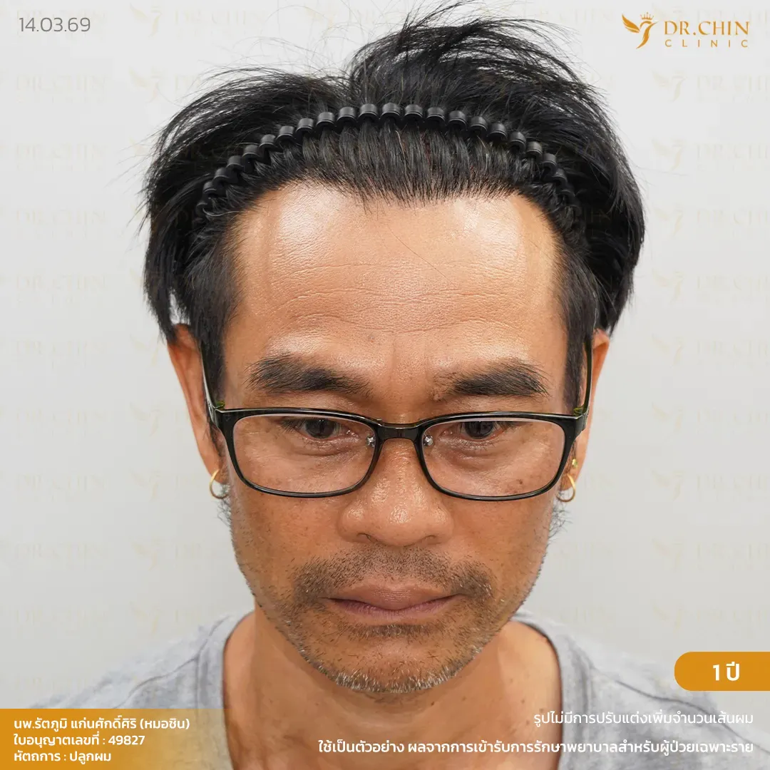 ก่อนปลูกผม DHI เคสแนวผมถอยตามวัยและผมบางด้านหน้า Doctor Chin Clinic