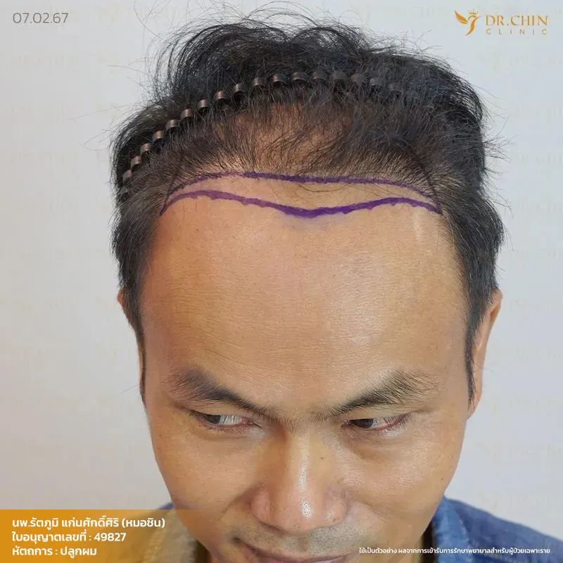 ภาพก่อนแก้ปลูกผม แนวผมด้านหน้าที่ต้องวางแผนปรับใหม่