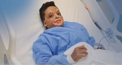 إنقاذ حياة وعلاج مريض حروق (زكاة) مع مؤسسة أهل مصر