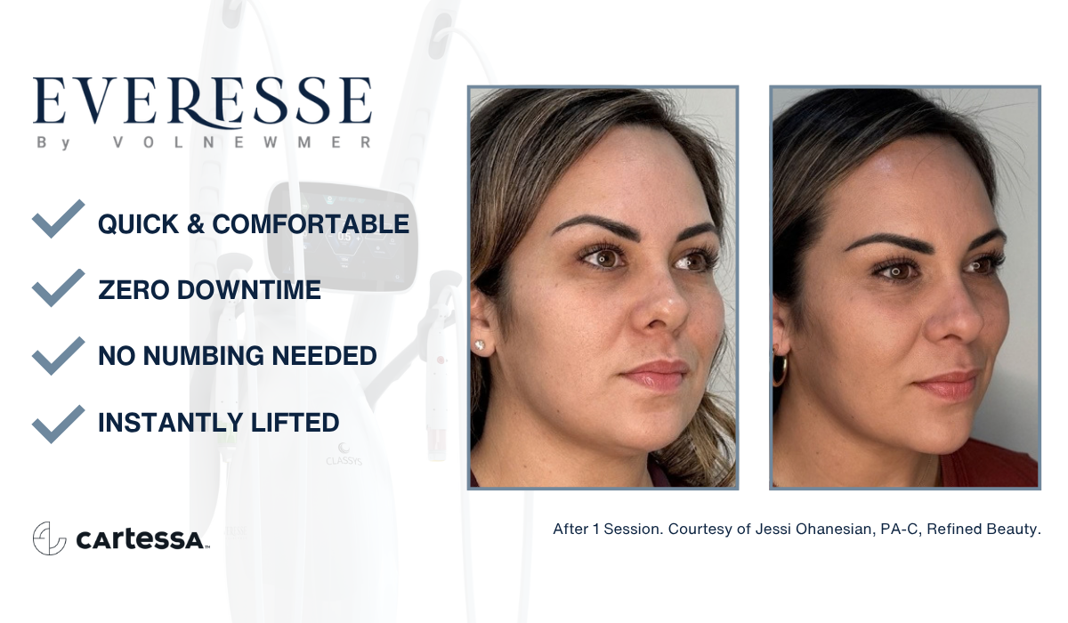 Sculptra Treatment Lancaster