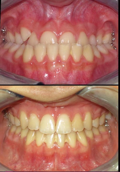 before and after treatment