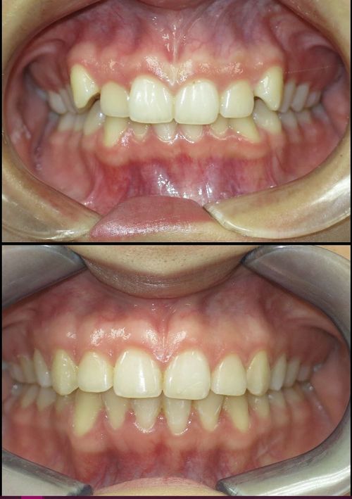 before and after treatment