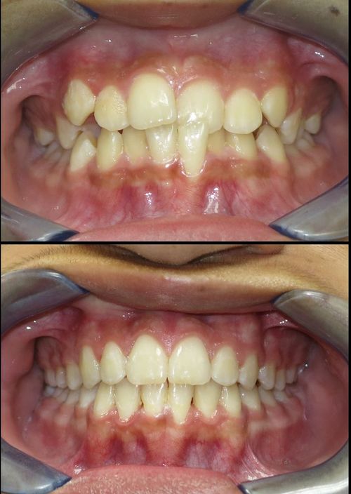 before and after treatment