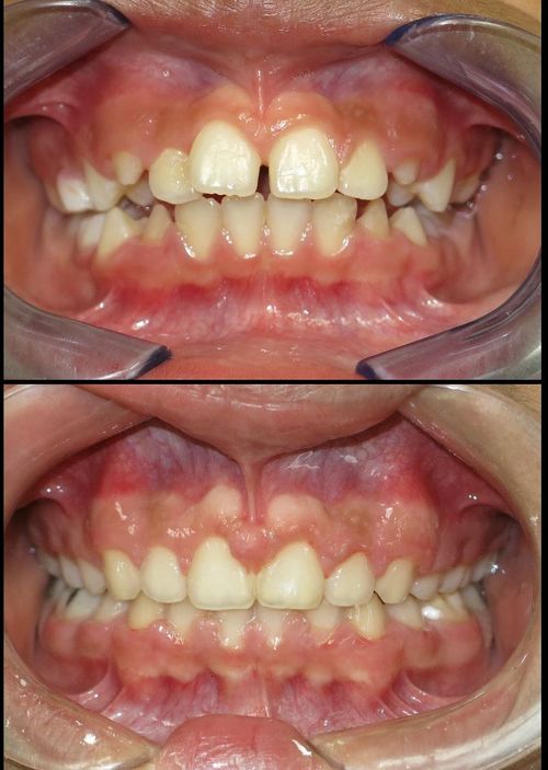 before and after treatment