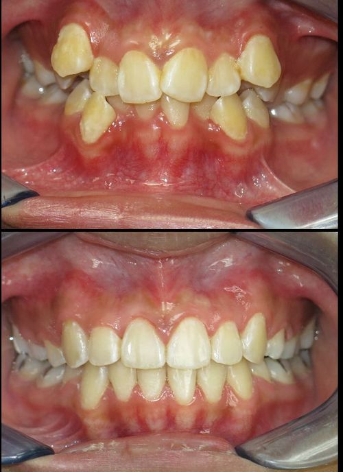 before and after treatment