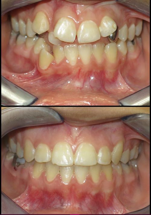 before and after treatment