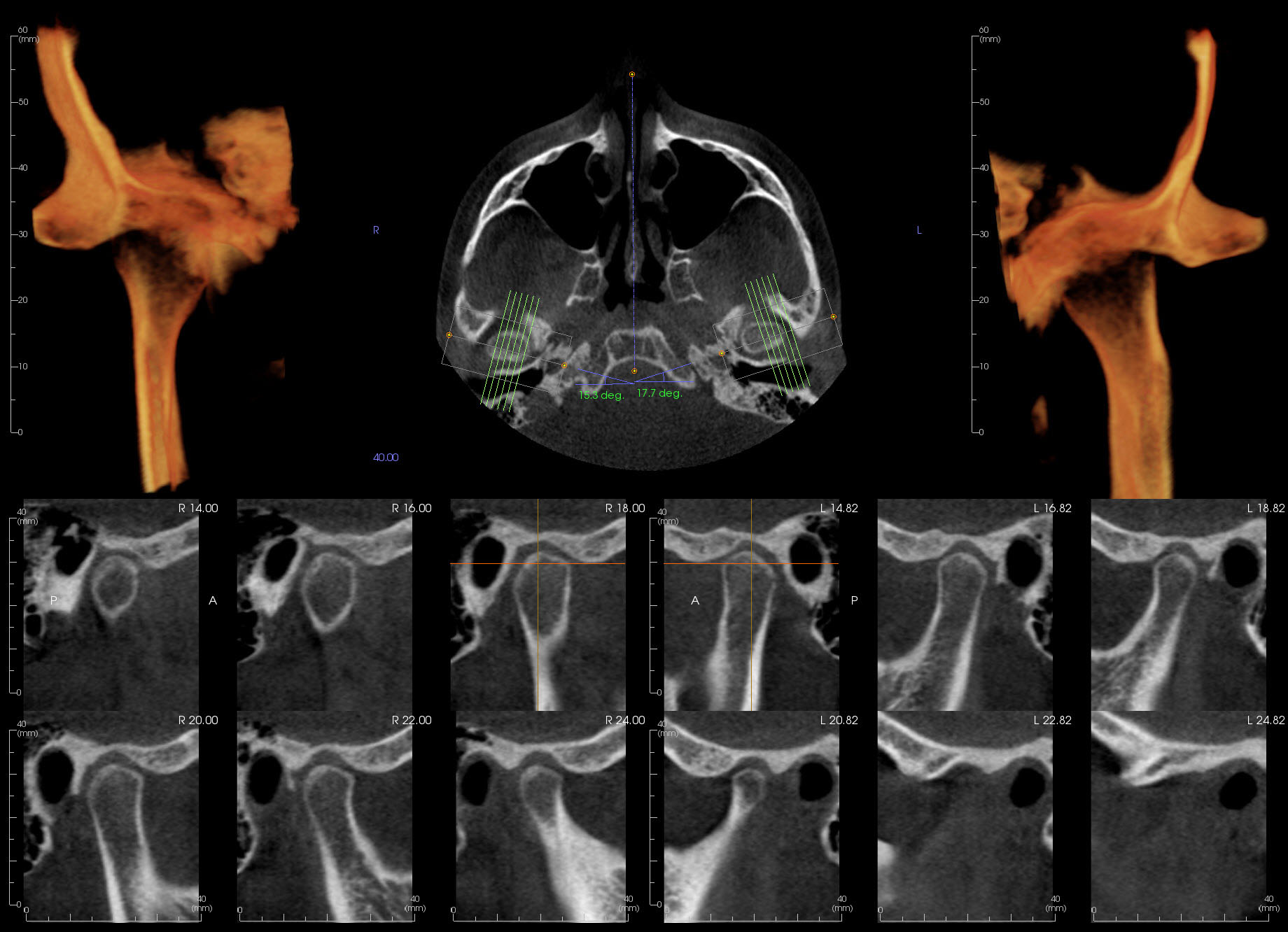 CBCT incidental findings