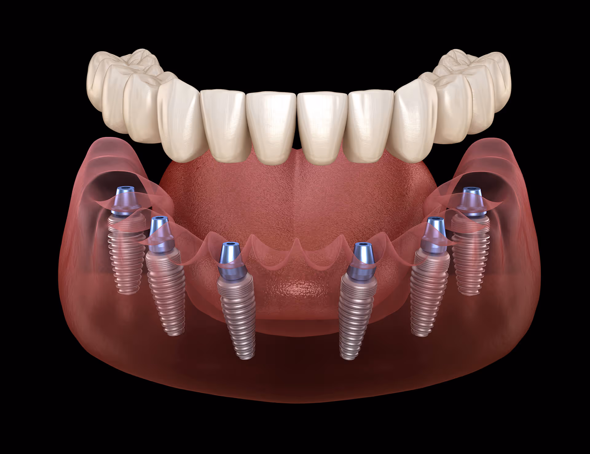 Snap-On Dentures in Centennial Hills, Las Vegas, NV