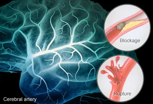 Blue brain with highlighted cerebral artery and insets showing artery blockage and rupture.