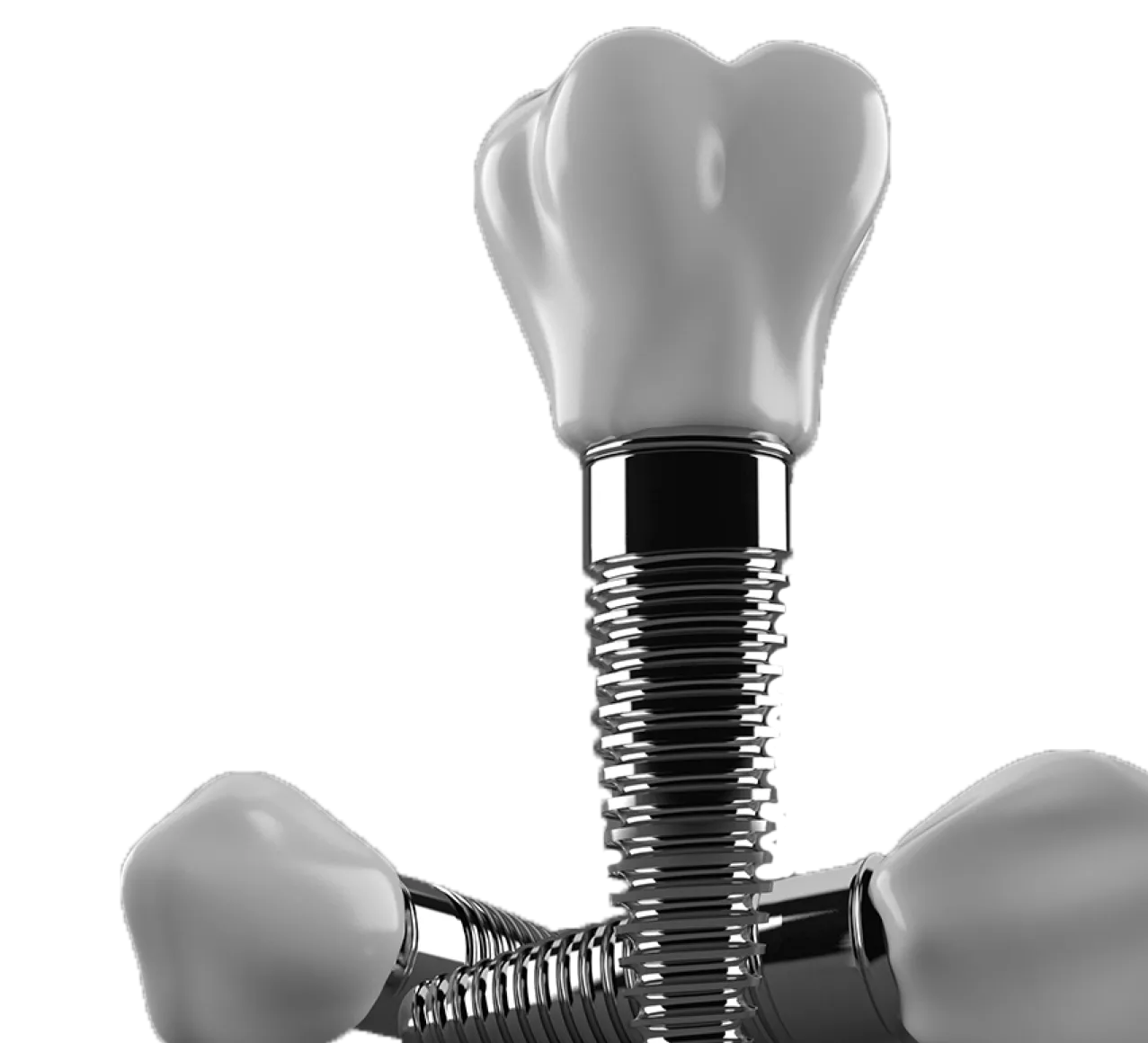 A dental model of a tooth and implants