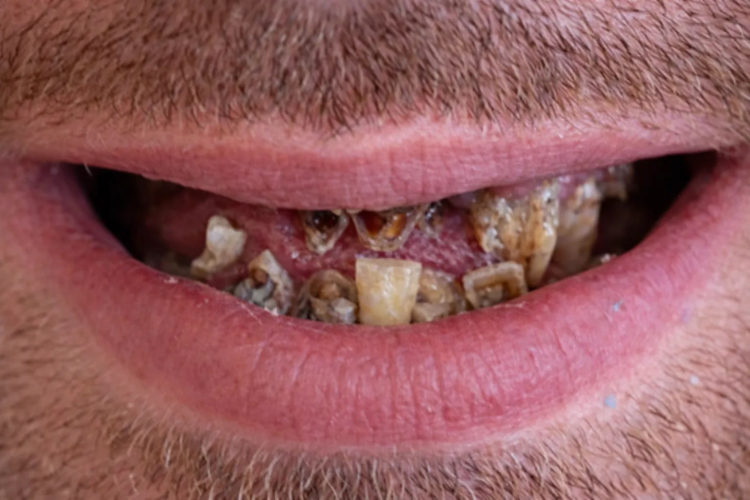 Close-up of a person's mouth with severely decayed, discolored, and misshapen teeth.