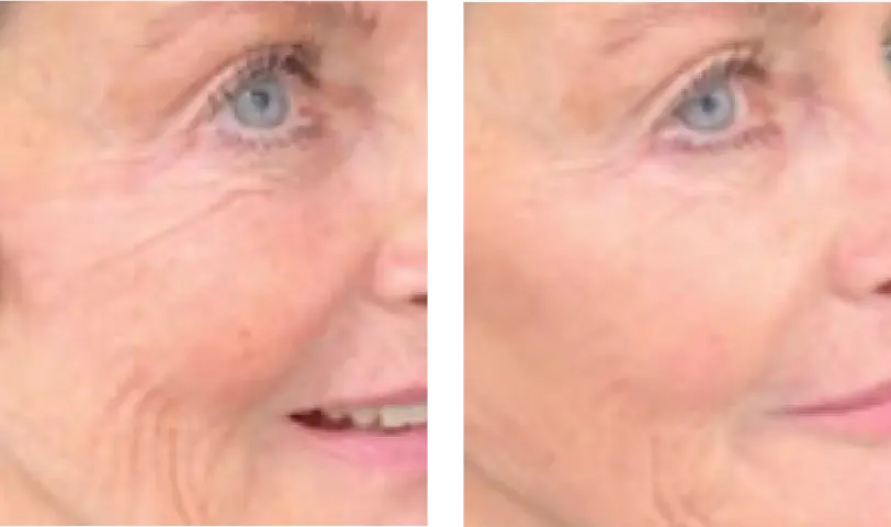 Male patient hair genix pre treatment