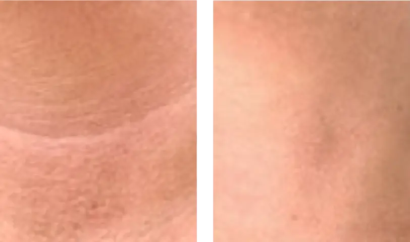 Male patient hair genix pre treatment