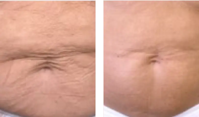 Before and After of Cheek Filler 