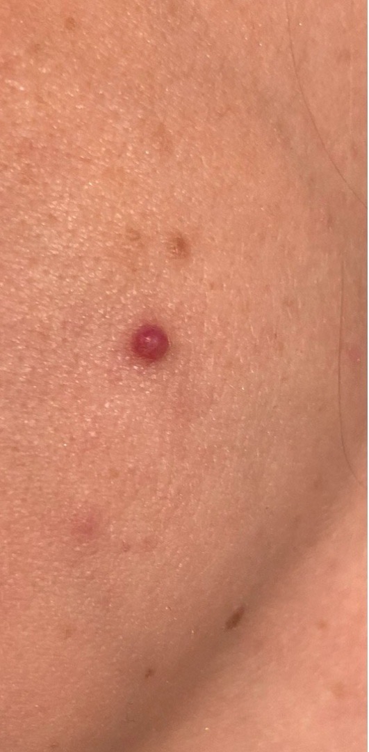 Close-up van bloedblaasje (cherry angioma) op het gezicht – rood bultje huid
