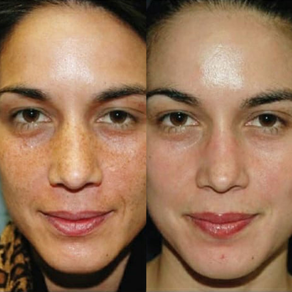 Voor- en nafoto van een vrouw met melasma (zwangerschapsmasker) na behandeling 