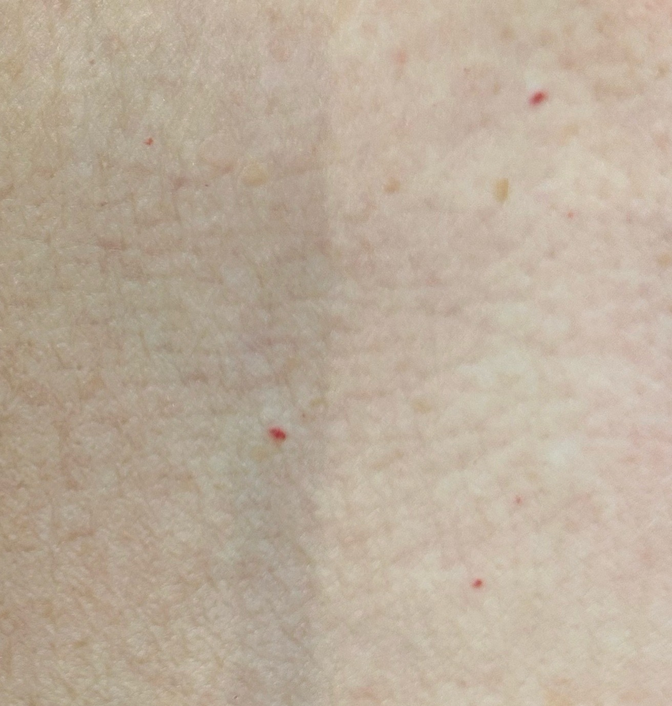 Close-up van bloedblaasjes op de romp, te behandelen bij Huidinstituut Mariposas in Enschede